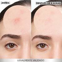 IMAGEN 8 PIMPLE PATCHES