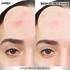 IMAGEN 8 PIMPLE PATCHES