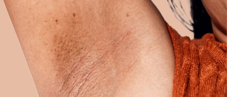 blanqueamiento de axilas